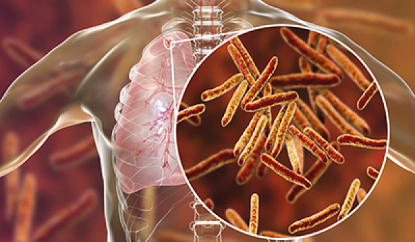 Жетісу облысында туберкулезбен науқастанғандар саны республикалық көрсеткіштен жоғары