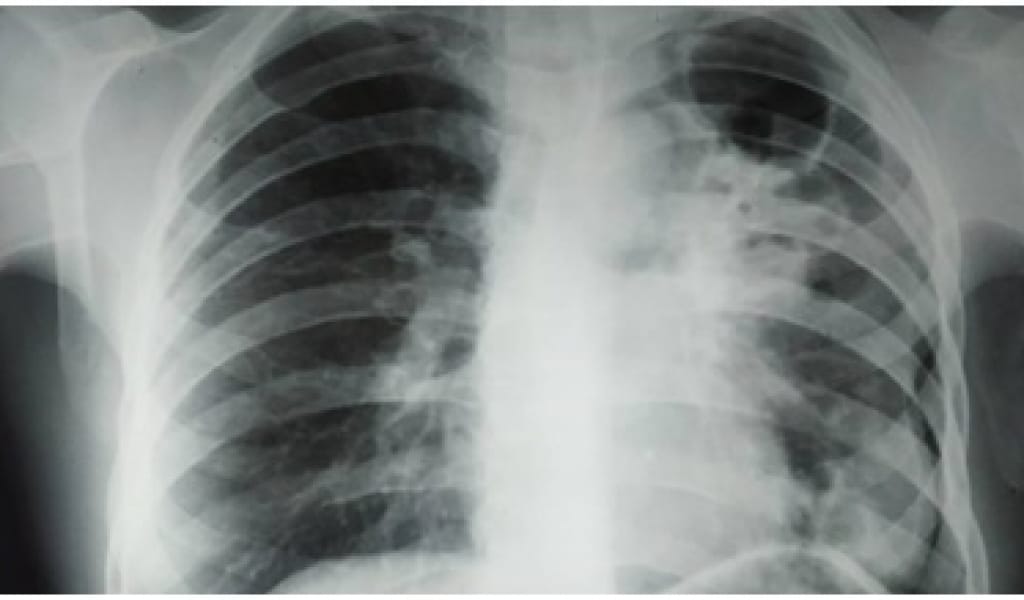 КОРОНАВИРУС ПЕН ТУБЕРКУЛЕЗДІҢ АЙЫРМАСЫ: МАМАН ТҮСІНДІРМЕСІ