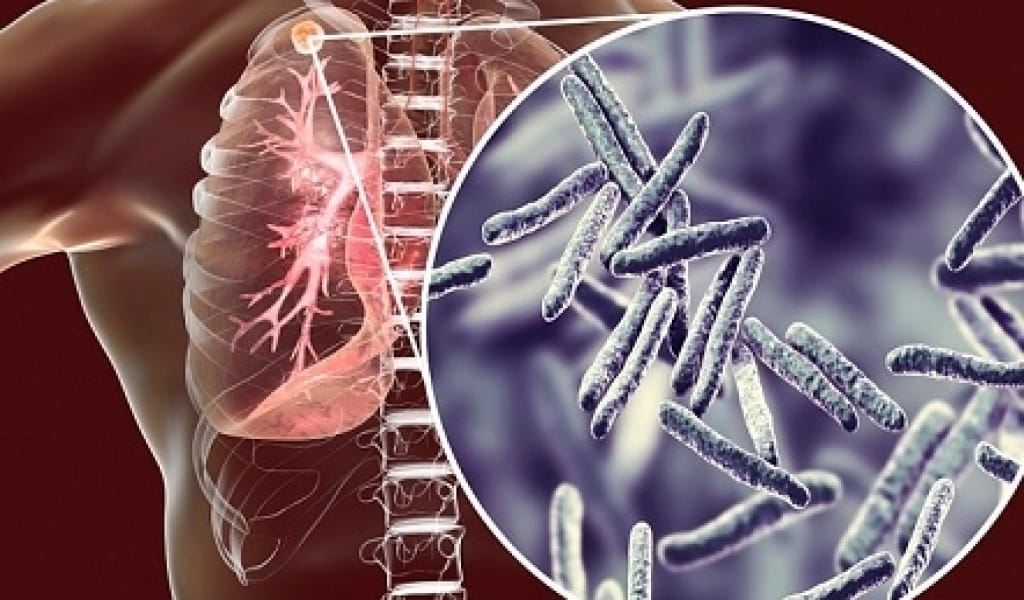 ДӘРІ-ДӘРМЕККЕ БОЙ БЕРМЕЙТІН ТУБЕРКУЛЕЗДІҢ ЖАҢА ТҮРІ КӨБЕЙІП БАРАДЫ