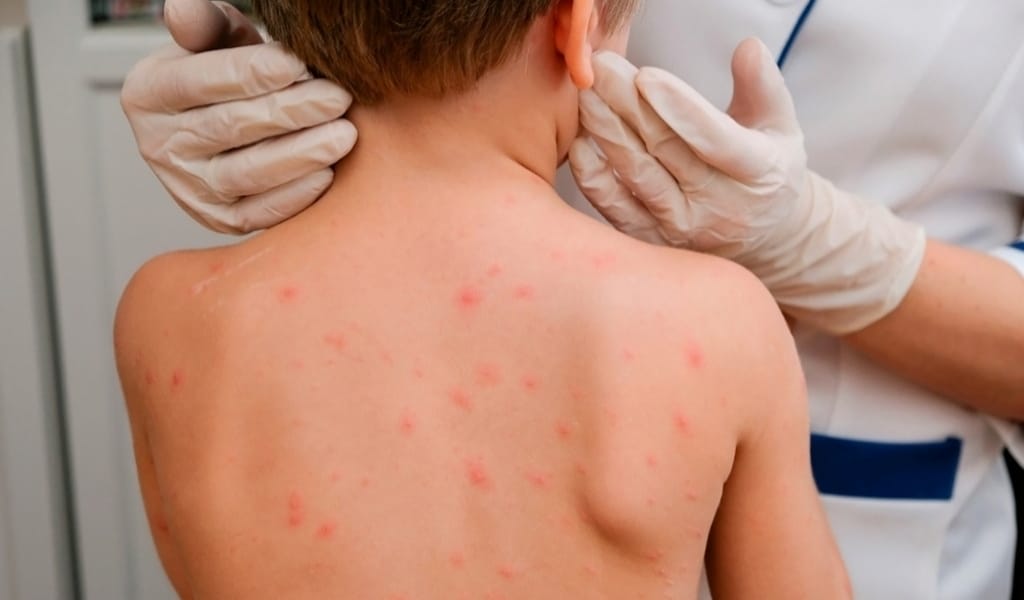 ҚЫЗЫЛША АУРУЫ АСҚЫНСА, МИ ІСІНІП, СОҚЫРЛЫҚҚА ӘКЕП СОҒУЫ МҮМКІН