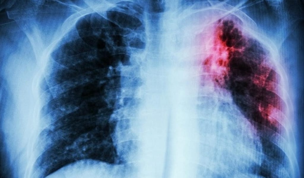 ӨЗІҢІЗДІ ЖӘНЕ БАЛАЛАРДЫ ТУБЕРКУЛЕЗДЕН ҚОРҒАҢЫЗ! ДӘРІГЕРДІҢ 7 КЕҢЕСІ