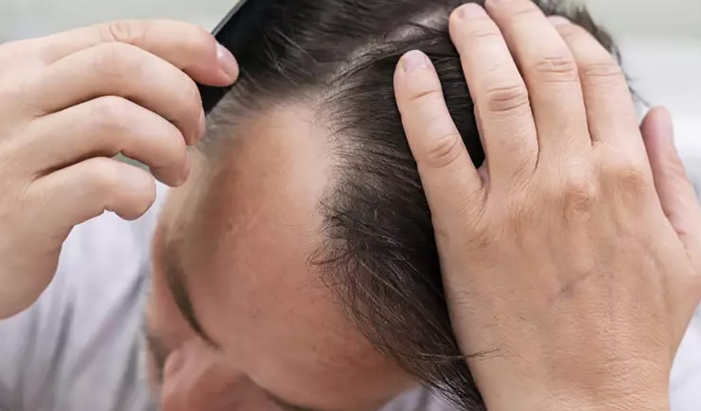 Ер адамдағы шаштың түсуін қалай тоқтатуға болады?