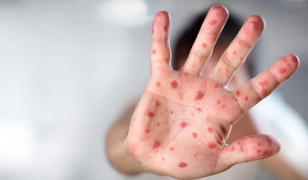 Қызылша ауруы өршіп тұр