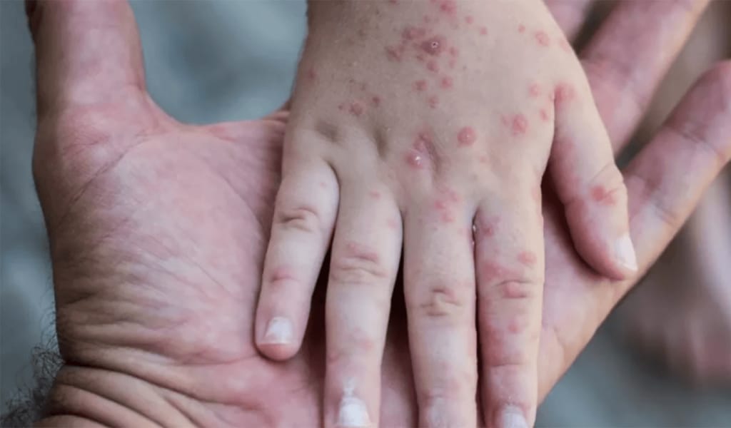 Қазақстан қызылша ауруы бойынша әлемде 1-орында тұр – БҰҰ