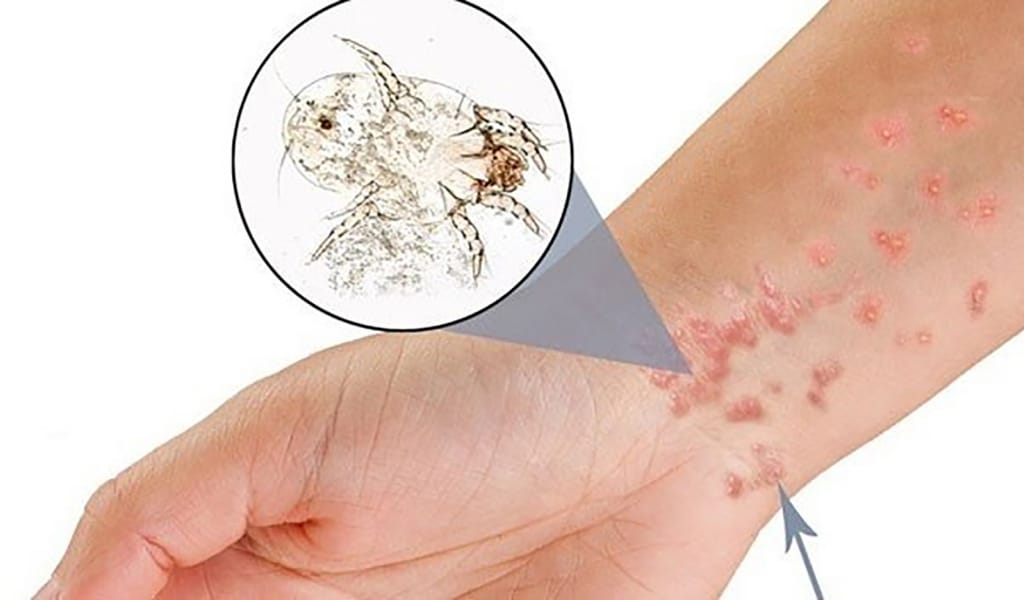 Қышыма – қатерлі жұқпа