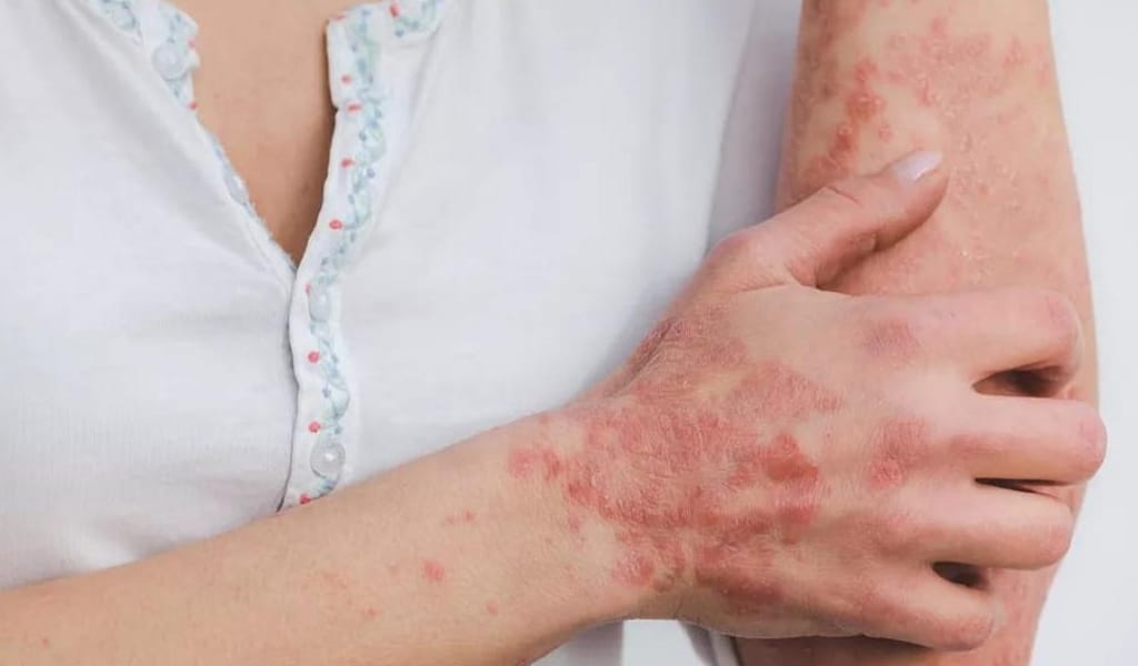 ҚАЗАҚСТАНДЫҚТАР ПСОРИАЗДЫ ИННОВАЦИЯЛЫҚ ЕМДЕУДІ ТЕГІН АЛАДЫ