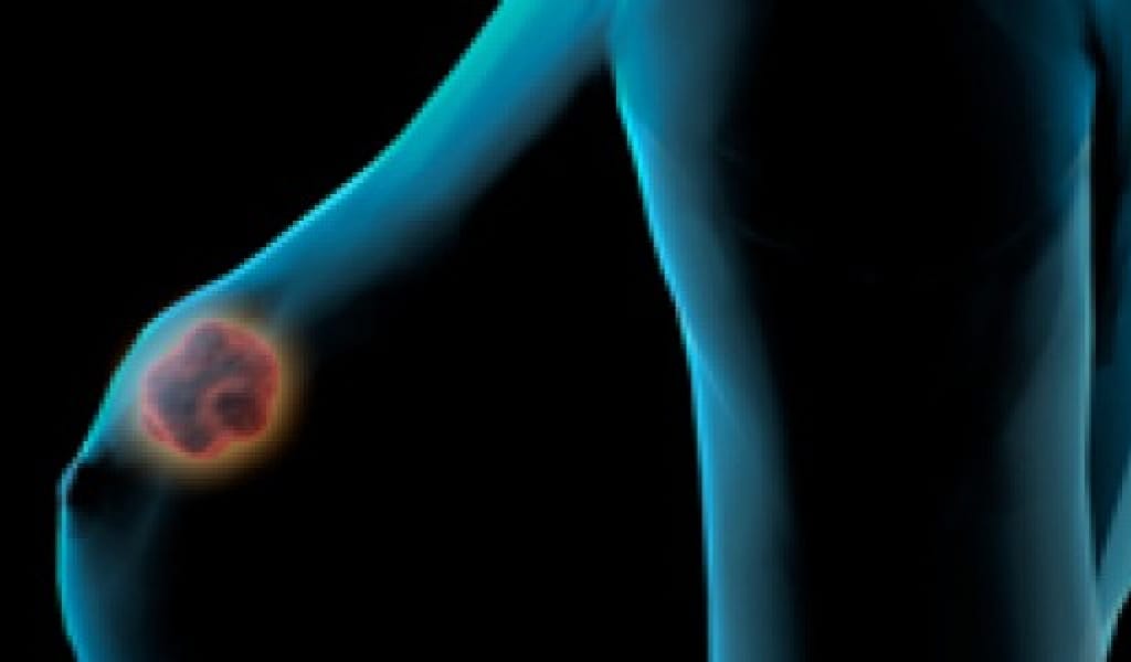 ТЕКСЕРІЛІҢІЗ: СҮТ БЕЗІ ҚАТЕРЛІ ІСІГІ ЕРКЕКТЕРДЕ ДЕ КЕЗДЕСЕДІ